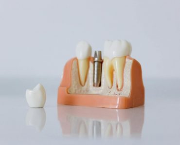 Implant dentar pret