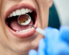 Aparate dentare Incognito