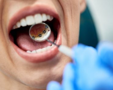 Aparate dentare Incognito